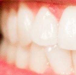 牙结石怎么去除,如何预防牙结石小窍门